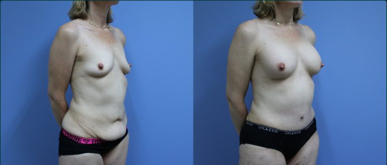 Post-pregnancy surgery before and after, 45° right view, female patient, case PPS-L09, Dr Rohit Kumar, Sydney