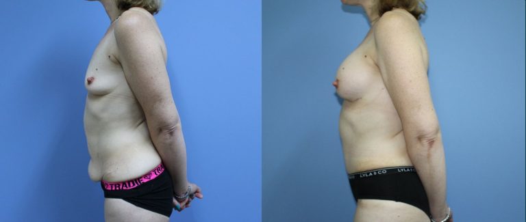 Post-pregnancy surgery before and after, 90° left view, female patient, case PPS-L09, Dr Rohit Kumar, Sydney