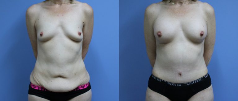 Post-pregnancy surgery before and after, front view, female patient, case PPS-L09, Dr Rohit Kumar, Sydney