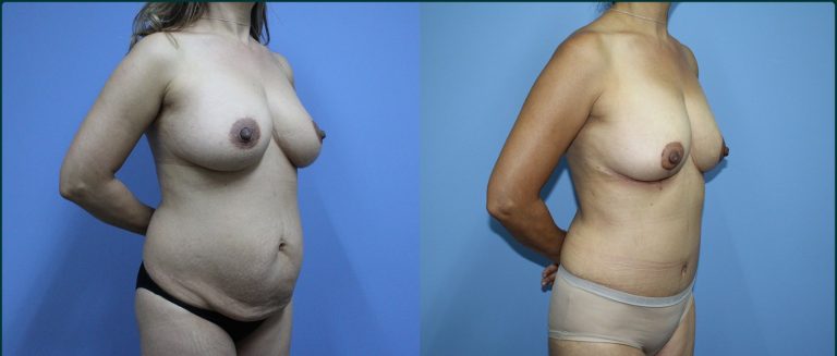 Post-pregnancy surgery before and after, 45° right view, female patient, case PPS-L10, Dr Rohit Kumar, Sydney