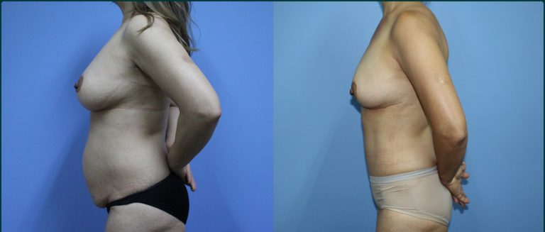 Post-pregnancy surgery before and after, 90° left view, female patient, case PPS-L10, Dr Rohit Kumar, Sydney