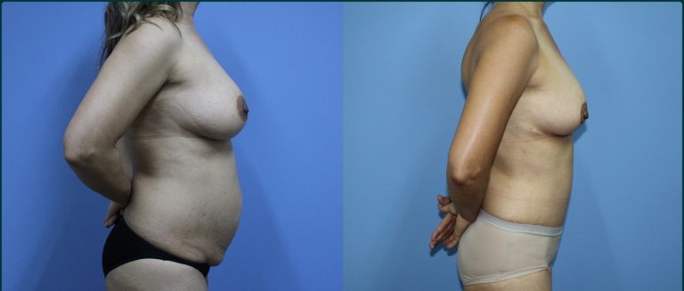 Post-pregnancy surgery before and after, 90° right view, female patient, case PPS-L10, Dr Rohit Kumar, Sydney