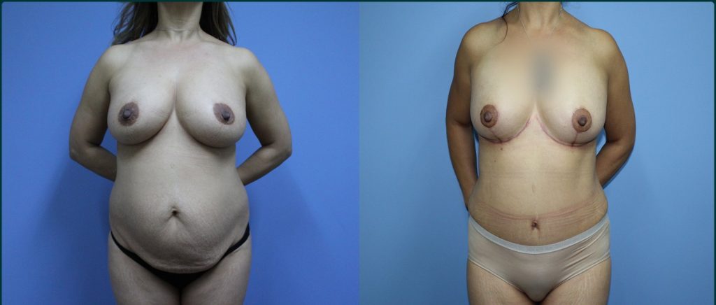 Post-pregnancy surgery before and after, front view, female patient, case PPS-L10, Dr Rohit Kumar, Sydney