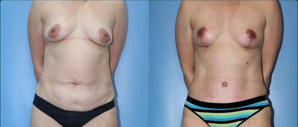 Post-pregnancy surgery before and after, female patient, case PPS-L11, Dr Rohit Kumar, Sydney