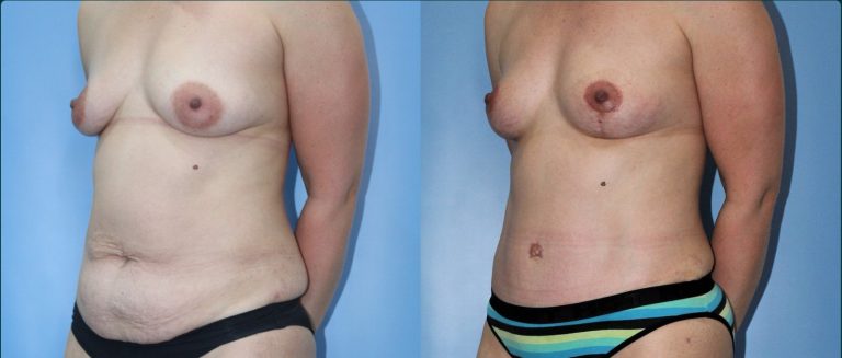 Post-pregnancy surgery before and after, female patient, case PPS-L11, Dr Rohit Kumar, Sydney
