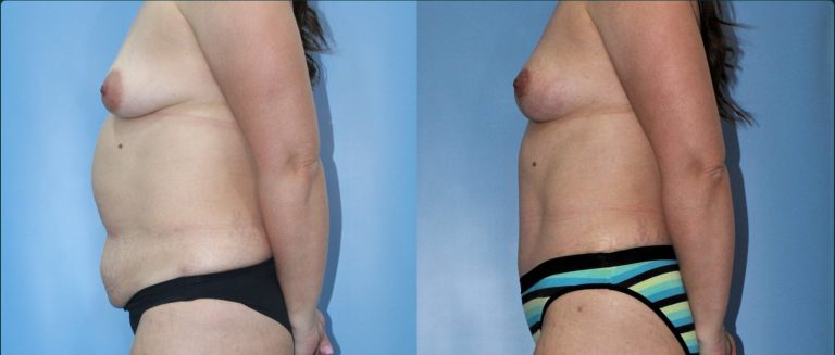 Post-pregnancy surgery before and after, female patient, case PPS-L11, Dr Rohit Kumar, Sydney