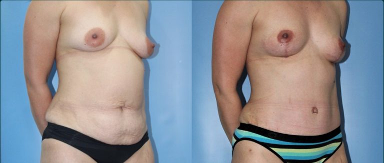 Post-pregnancy surgery before and after, female patient, case PPS-L11, Dr Rohit Kumar, Sydney