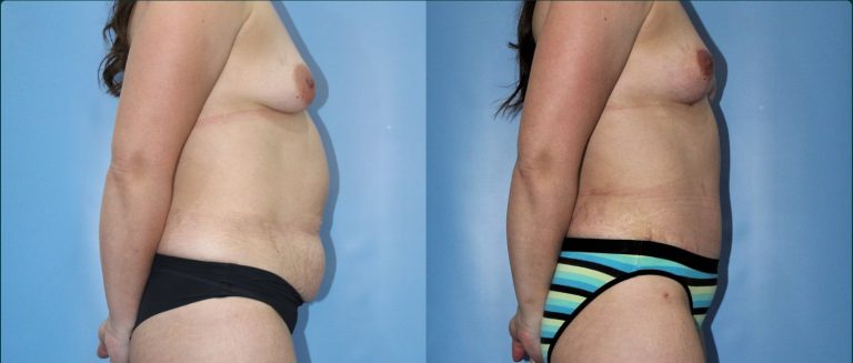 Post-pregnancy surgery before and after, female patient, case PPS-L11, Dr Rohit Kumar, Sydney