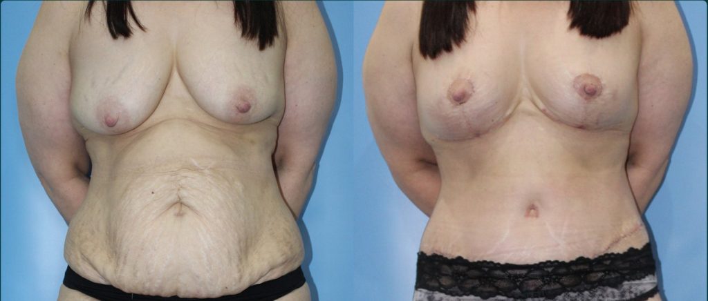 Post-pregnancy surgery before and after, female patient, case PPS-L12, Dr Rohit Kumar, Sydney