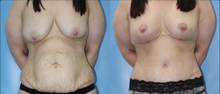 Post-pregnancy surgery before and after, female patient, case PPS-L12, Dr Rohit Kumar, Sydney