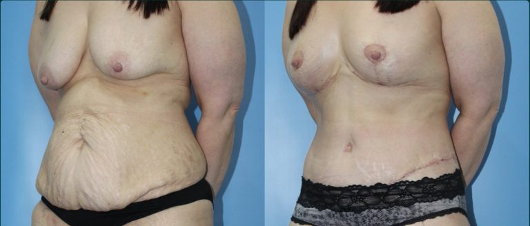 Post-pregnancy surgery before and after, female patient, case PPS-L12, Dr Rohit Kumar, Sydney