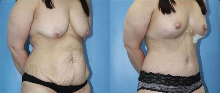 Post-pregnancy surgery before and after, female patient, case PPS-L12, Dr Rohit Kumar, Sydney