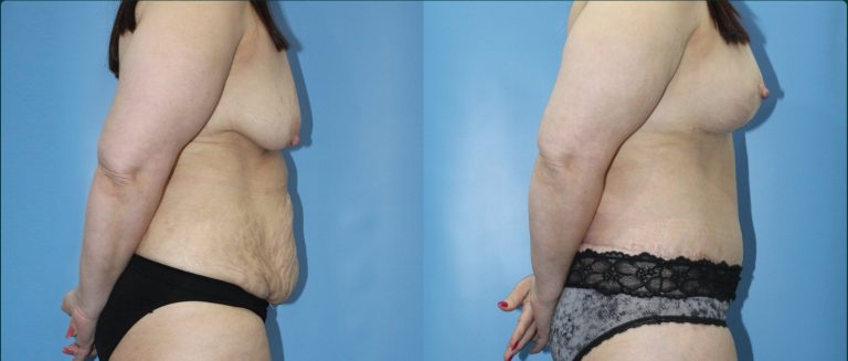 Post-pregnancy surgery before and after, female patient, case PPS-L12, Dr Rohit Kumar, Sydney