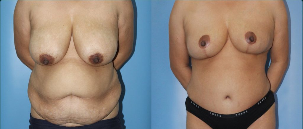Post-pregnancy surgery before and after, female patient, case PPS-L13, Dr Rohit Kumar, Sydney