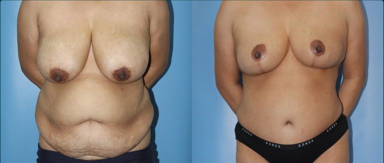 Post-pregnancy surgery before and after, female patient, case PPS-L13, Dr Rohit Kumar, Sydney