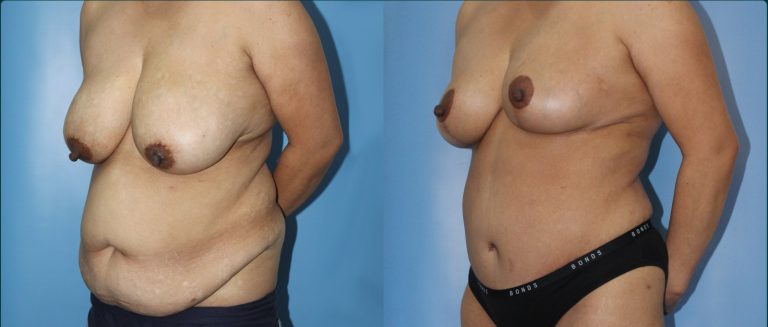 Post-pregnancy surgery before and after, female patient, case PPS-L13, Dr Rohit Kumar, Sydney