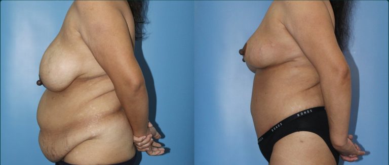 Post-pregnancy surgery before and after, female patient, case PPS-L13, Dr Rohit Kumar, Sydney