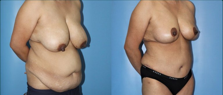 Post-pregnancy surgery before and after, female patient, case PPS-L13, Dr Rohit Kumar, Sydney
