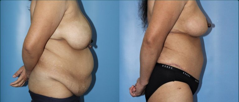 Post-pregnancy surgery before and after, female patient, case PPS-L13, Dr Rohit Kumar, Sydney